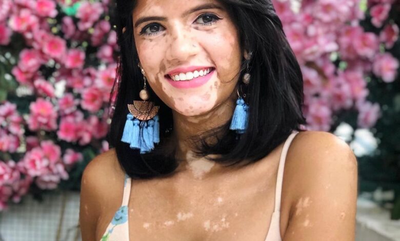 This Malaysian woman with vitiligo is redefining the beauty standards 1 sonya danita charles vitiligo
