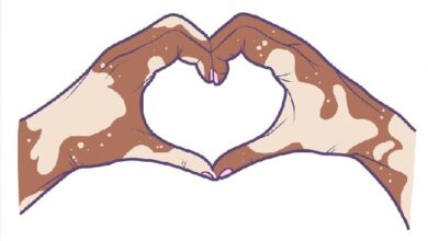 Top 10 tips for Dating Success with Vitiligo 18 Vitiligo Dating Tips